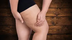 Da dove viene la cellulite e si può davvero eliminarla?